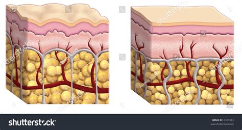 Diagram illustrating the layers of skin and subcutaneous tissue, highlighting fat cells and connective tissue fibers.