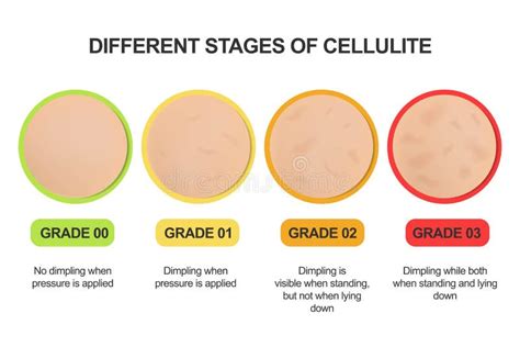 Visual representation of the three stages of cellulite, showing increasing severity of dimpling and texture changes.