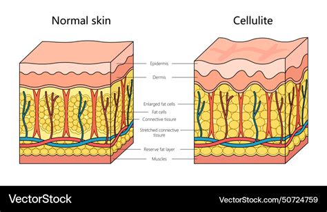 Diagram comparing normal skin structure with skin affected by cellulite, showing fat cells, connective tissue, and vascularization.