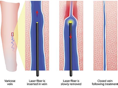 Diagram illustrating how EVLT or RFA procedures close off diseased veins.