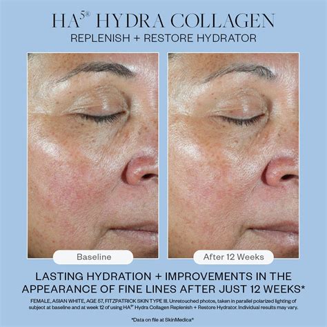 before and after comparison of skin treated with HA5 Hydra Collagen
