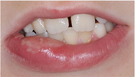 Diagram illustrating the areas of the mouth susceptible to biting after local anesthesia: lips, tongue, and cheeks.