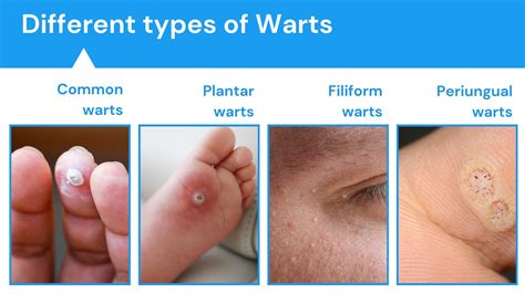 Diagram illustrating the layers of skin infected by HPV causing plantar warts, with emphasis on the black pinpoints (clotted blood vessels).