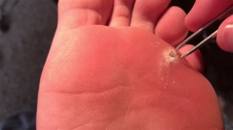 Illustration showing the wrong way to treat a plantar wart: tweezers pulling at the wart, and a knife attempting to cut it, with red 'X' marks indicating danger.