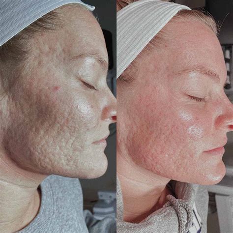Before and after photos showing improvement in acne scarring and hyperpigmentation after a Jessner peel