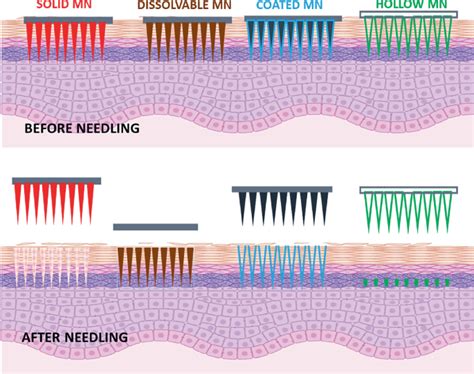 Illustration comparing different types of microneedles (solid, coated, hollow, dissolvable).