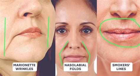 Diagram illustrating the location of nasolabial folds and marionette lines on the face.