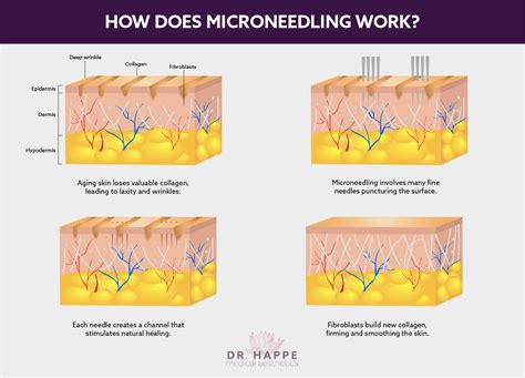 Diagram illustrating the process of microneedling and its effect on collagen production.