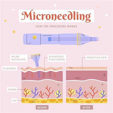 Infographic explaining the process of microneedling and its benefits for skin regeneration.