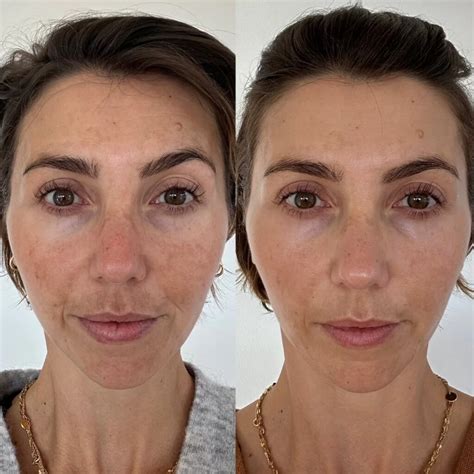 Side-by-side comparison photos showing the skin's texture and clarity before and after the first microneedling treatment.
