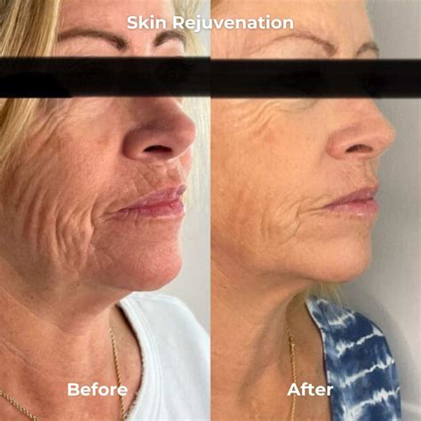 Close-up before and after images highlighting the reduction in fine lines and wrinkles after microneedling.