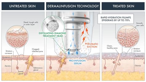 Infographic illustrating the three steps of Dermalinfusion: Exfoliation, Extraction, and Infusion.
