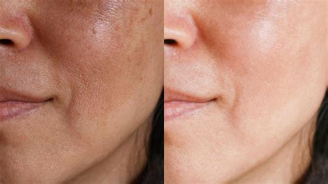 Split image showing uneven skin tone before and a brighter, more even complexion after regular use of black currant products.