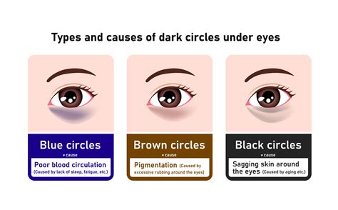 Diagram illustrating the difference between dark circles (pigmentation/shadows) and under-eye bags (puffiness)