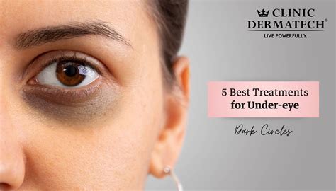 Comparison table of professional treatments for dark circles, outlining benefits and suitability