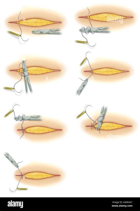 Illustration showing the steps of a surgical earlobe repair, from incision to suturing.