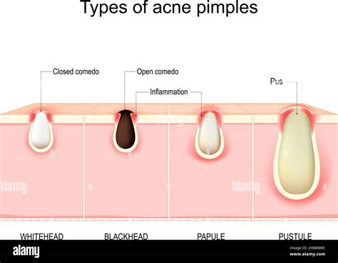 Diagram showing cross-section of different types of acne lesions: blackhead, whitehead, papule, pustule, nodule, cyst.