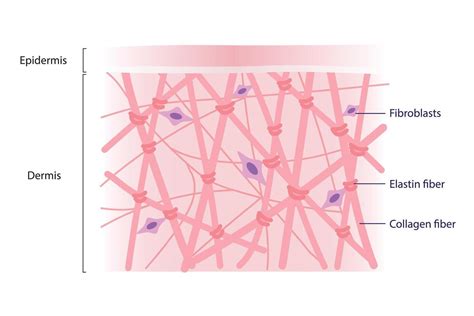 Infographic illustrating the layers of skin and how stretch marks form due to tearing of collagen and elastin fibers in the dermis.