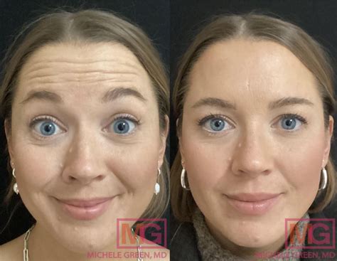 Collage of compelling before-and-after photos from Botox treatments