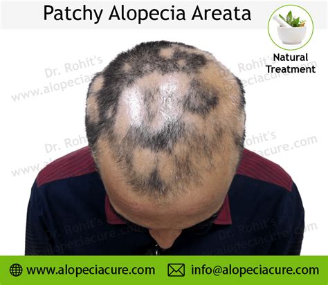Dermatologist examining a patient with alopecia areata