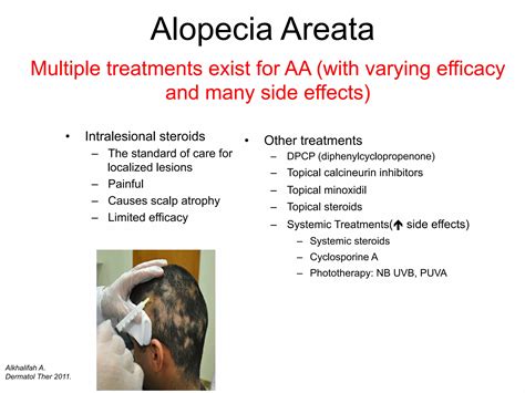 Comparison table of alopecia areata treatments, including efficacy and side effects