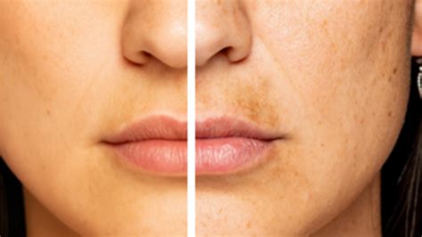 Before and after images showcasing reduction in dark spots and increased skin brightness
