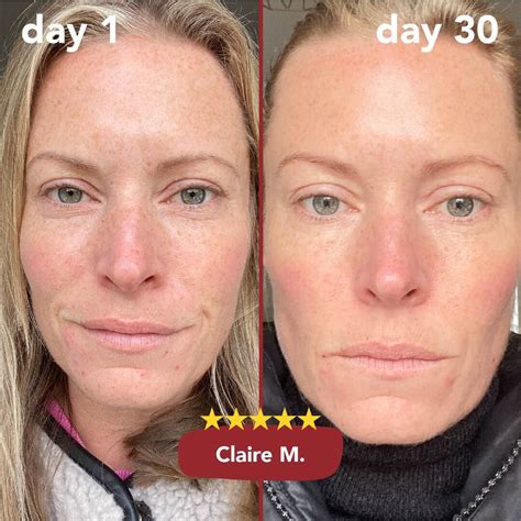 Before and after images showing improved skin hydration and elasticity after collagen supplementation.