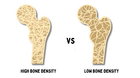 X-ray images comparing bone density with and without collagen supplementation.