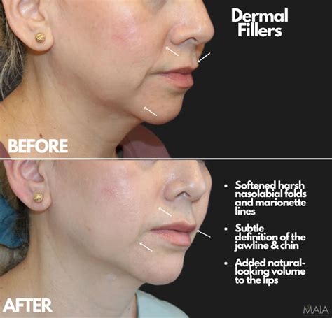 Before and after images showcasing Juvederm treatments for different facial areas (e.g., lips, cheeks, nasolabial folds).