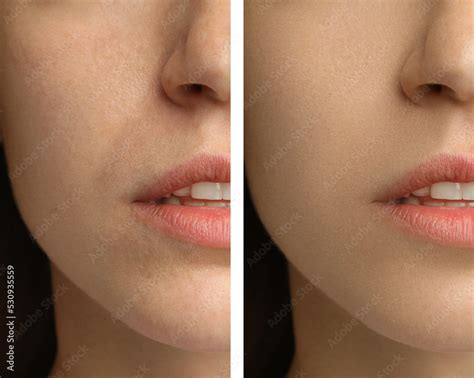 Before and after image demonstrating the effect of slugging with Aquaphor on dry, flaky skin.
