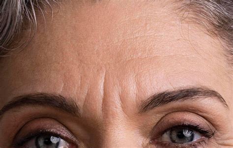 A close-up photograph of a person's forehead showing the 