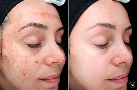 Before and after photos of cosmetic treatments like Botox or chemical peels