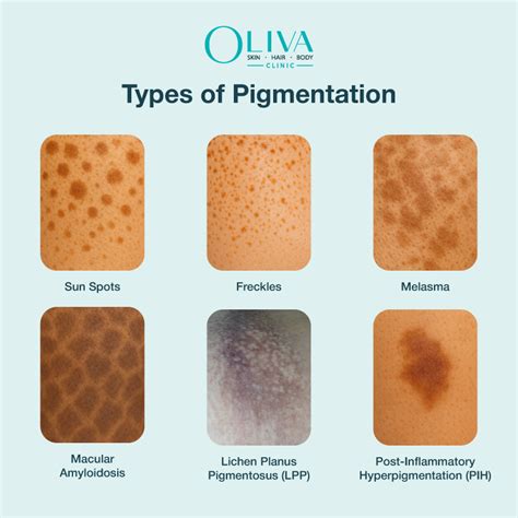 A close-up shot illustrating different types of hyperpigmentation on various skin tones: sun spots, post-acne marks, and melasma patches.