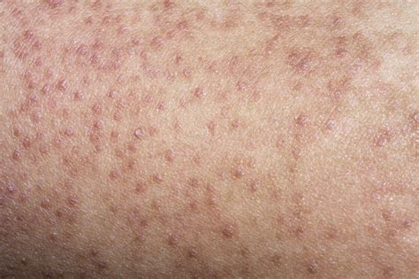 Close-up image illustrating the appearance of keratosis pilaris on the arm.