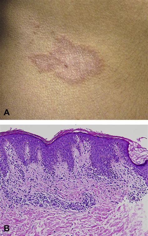 Clinical presentation of annular lichenoid dermatitis of youth showing annular plaques with clear centres and indurated borders.