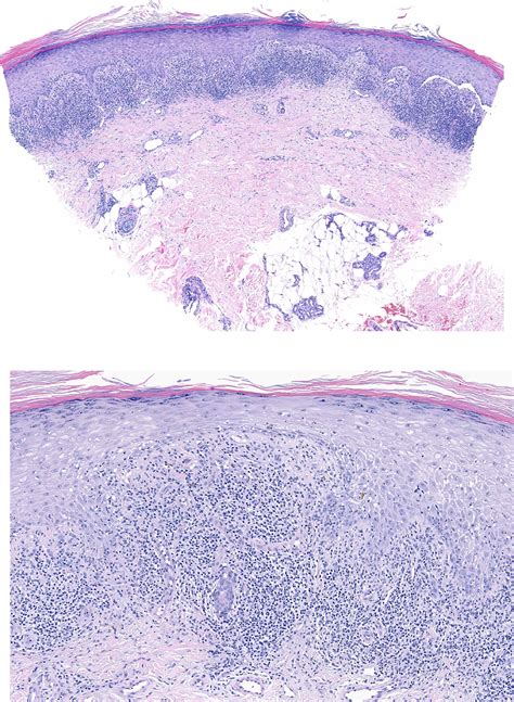 Histopathology of annular lichenoid dermatitis of youth showing elongated rete ridges, basal layer degeneration, apoptotic keratinocytes, and perivascular infiltrate.