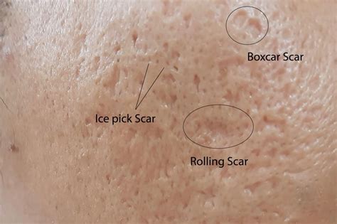 Close-up image showcasing the appearance of ice pick scars on skin.