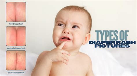 Illustration of a baby's bottom with mild diaper rash, showing redness and irritation.