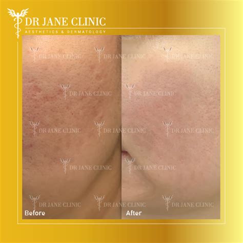 Before and after photos showcasing Pico Laser results for pigmentation and acne scars.