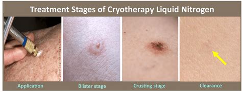 Diagram illustrating the process of cryotherapy for seborrheic keratosis removal.
