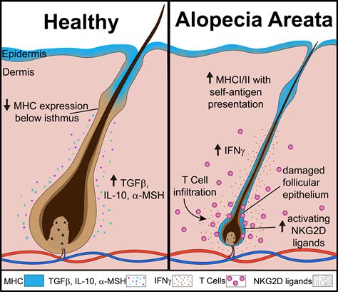 Diagram illustrating the autoimmune attack on hair follicles in alopecia areata.