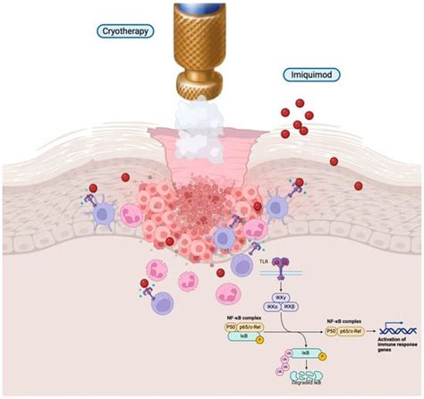 Illustration of skin reaction to topical immunotherapy agent.