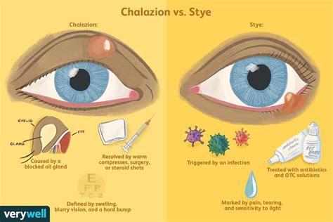 Diagram illustrating the difference between a stye and a chalazion on the eyelid.