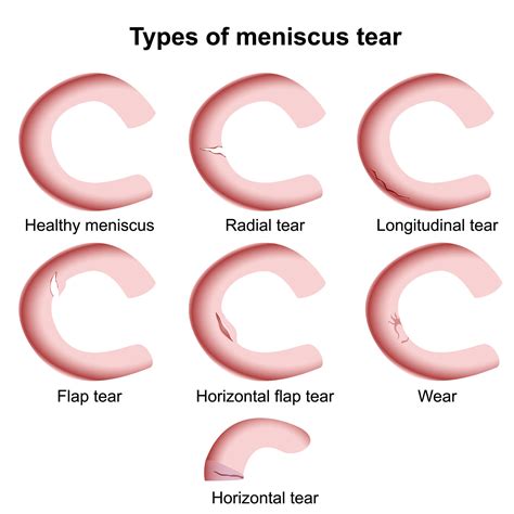 Illustration of different types of meniscus tears: vertical, bucket-handle, radial, and horizontal cleavage.