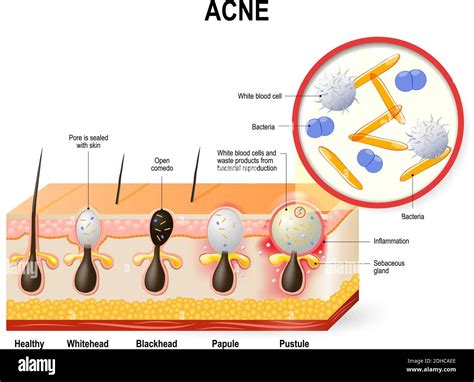 Infographic illustrating the causes of acne: excess sebum, dead skin cells, bacteria, hormones, diet, stress.