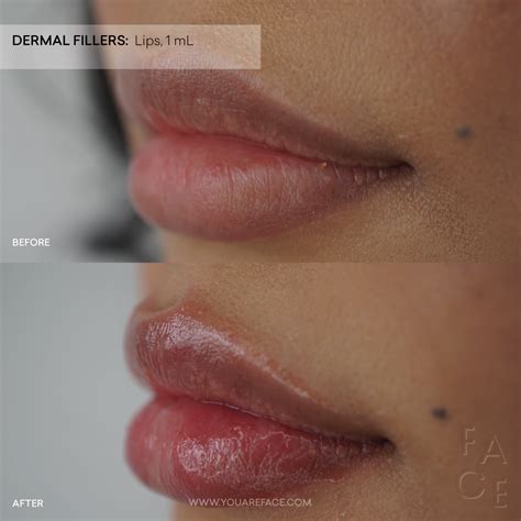 Infographic detailing preventative measures for lip filler lumps, including injection technique and aftercare.
