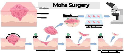 Illustration depicting the steps of Mohs surgery for skin cancer removal.