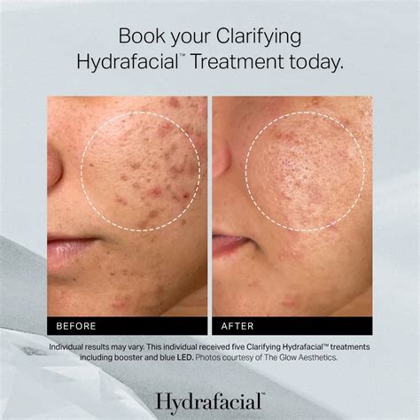 Before and after comparison photos of HydraFacial treatments