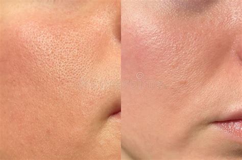 Split image showing a comparison of skin texture before and after applying matte powder