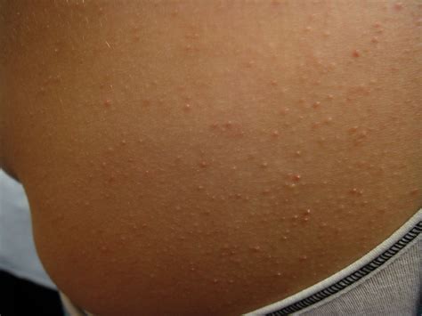 Close-up image showing the characteristic small, rough bumps of Keratosis Pilaris on the arm.